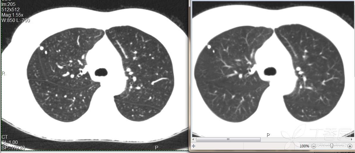 一图看清薄层ct与普通ct的差别