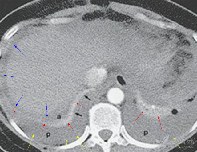 ct上如何鉴别胸腔积液还是腹腔积液