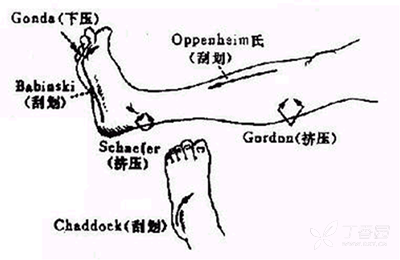 3,跖反射 l1-2 4,肛门反射(s4-5 三,病理反射 1,巴宾斯基(babinski