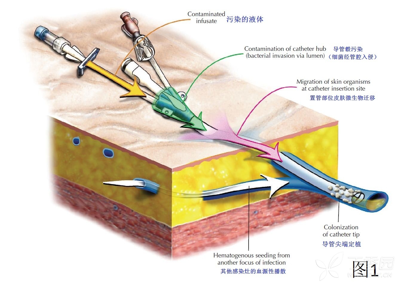 易学习(7,一图读懂:导管相关感染发病机制