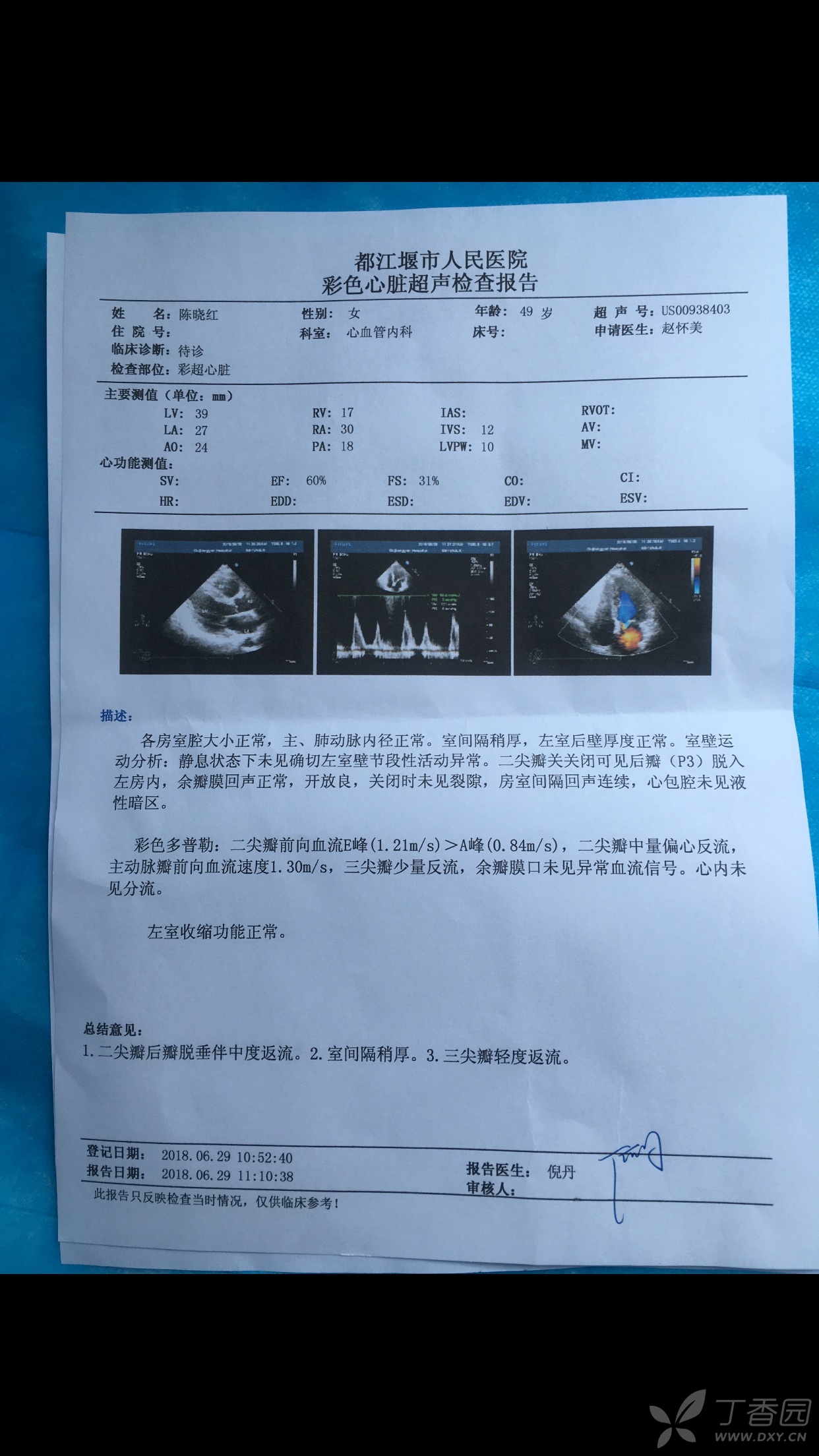 二尖瓣后瓣脱垂伴中度返流目前需要手术吗