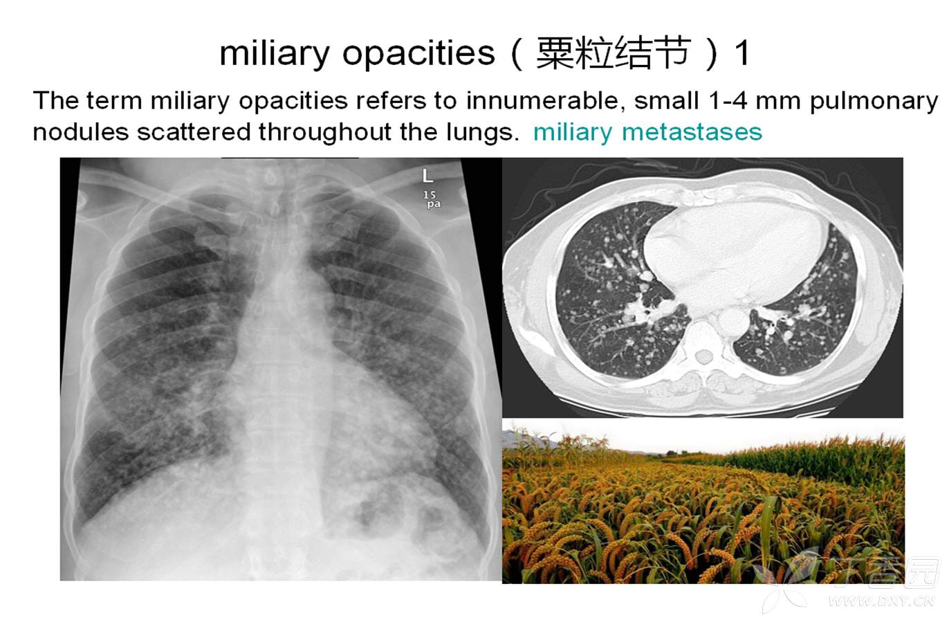 miliary opacities(粟粒结节)1