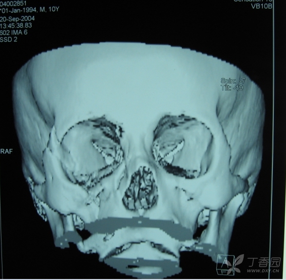复合型眶壁骨折-------眼科子版看图说话