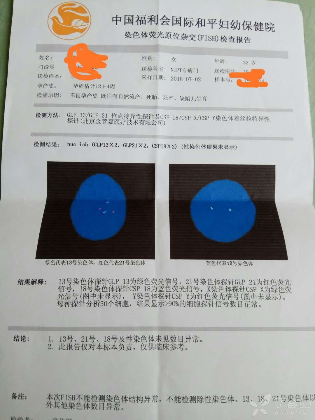 求助:羊水fish正常,核型报告:性染色体嵌合体46xy(12个)和46xx(7个)