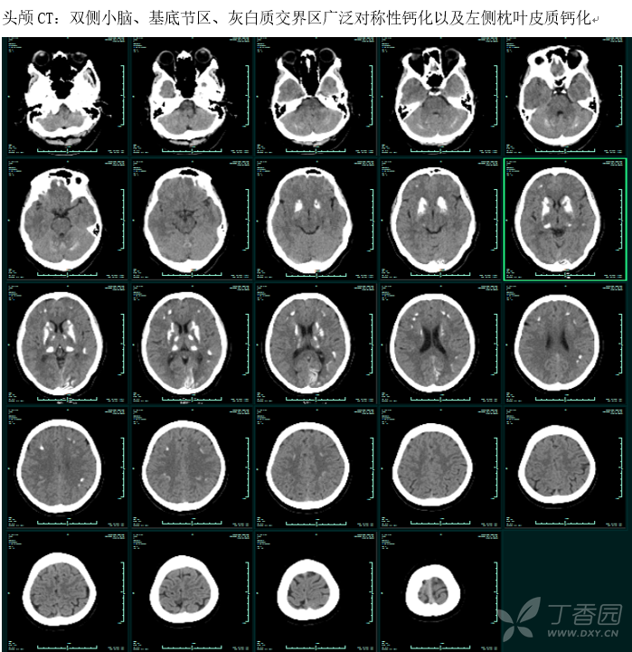 辅助检查:头颅ct(见下图):双侧小脑,基底节区,灰白质交界区广泛对称