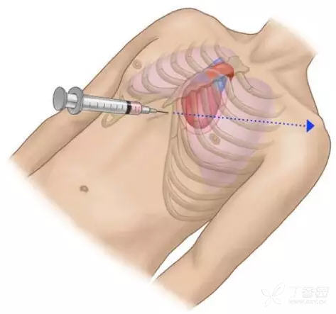 有条件时应在超声指导下选择穿刺点和调整进针角度,深度避免损伤心肌