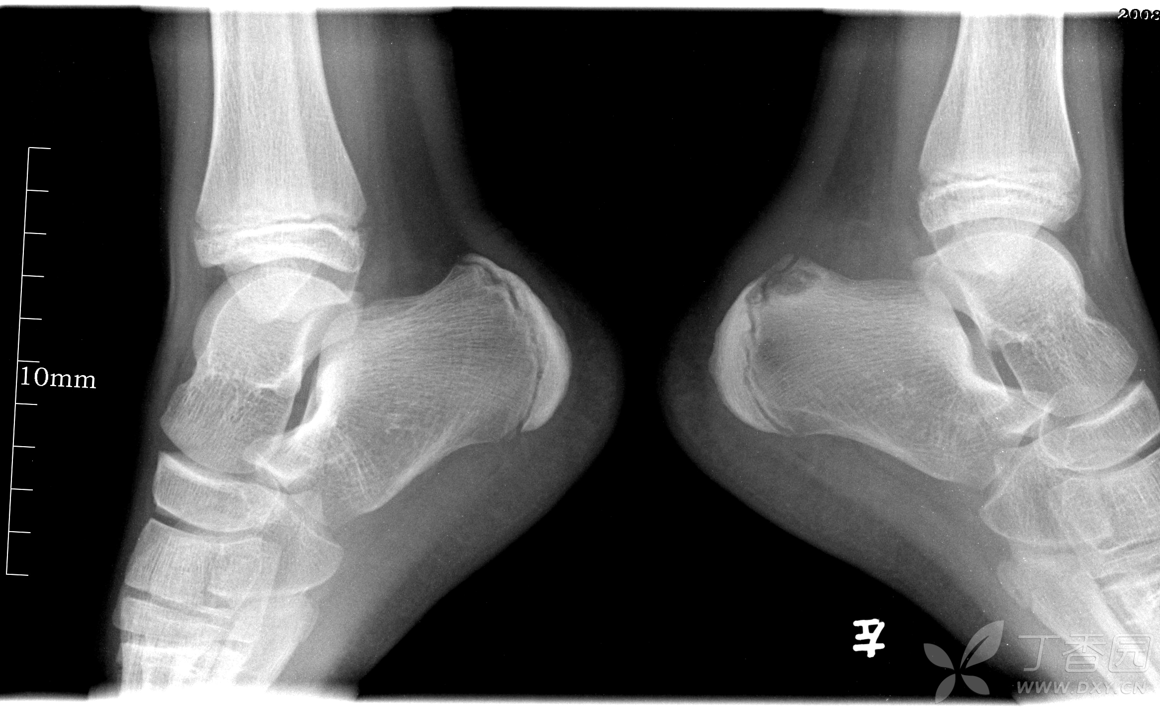 疼痛影像二三事系列之四-踝关节(优质回帖有礼[精华]