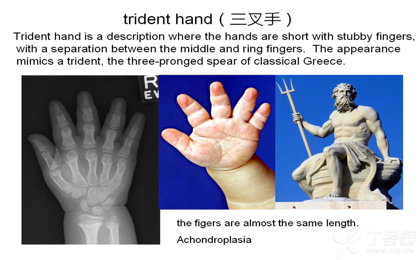 trident hand(三叉手)