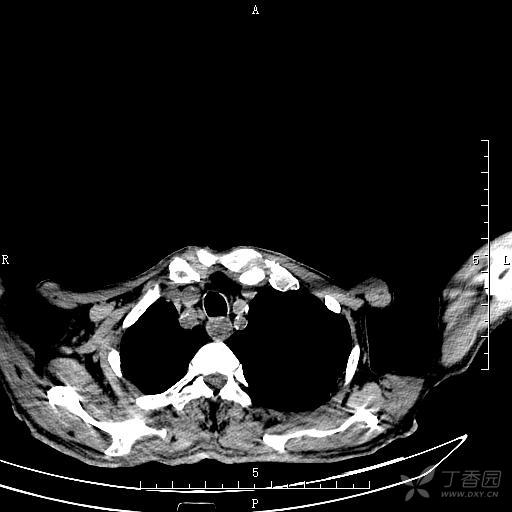 胸部ct:气管食管瘘?