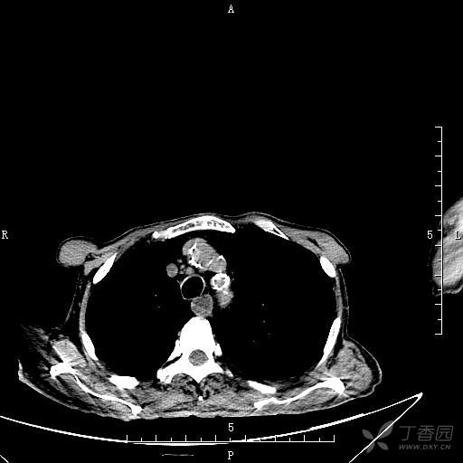 胸部ct:气管食管瘘?