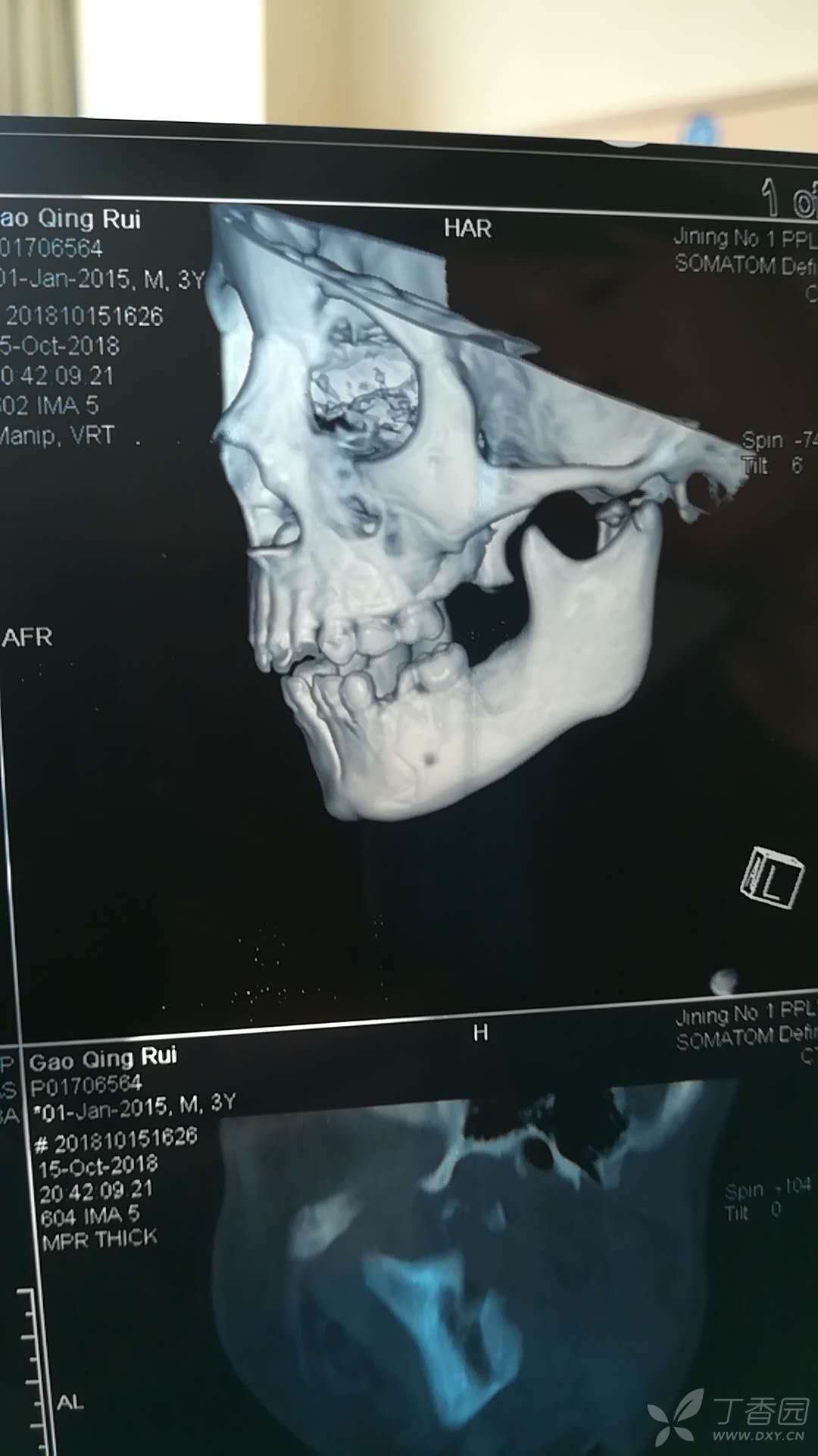 双侧髁突粉碎性骨折 下颌骨骨体骨折