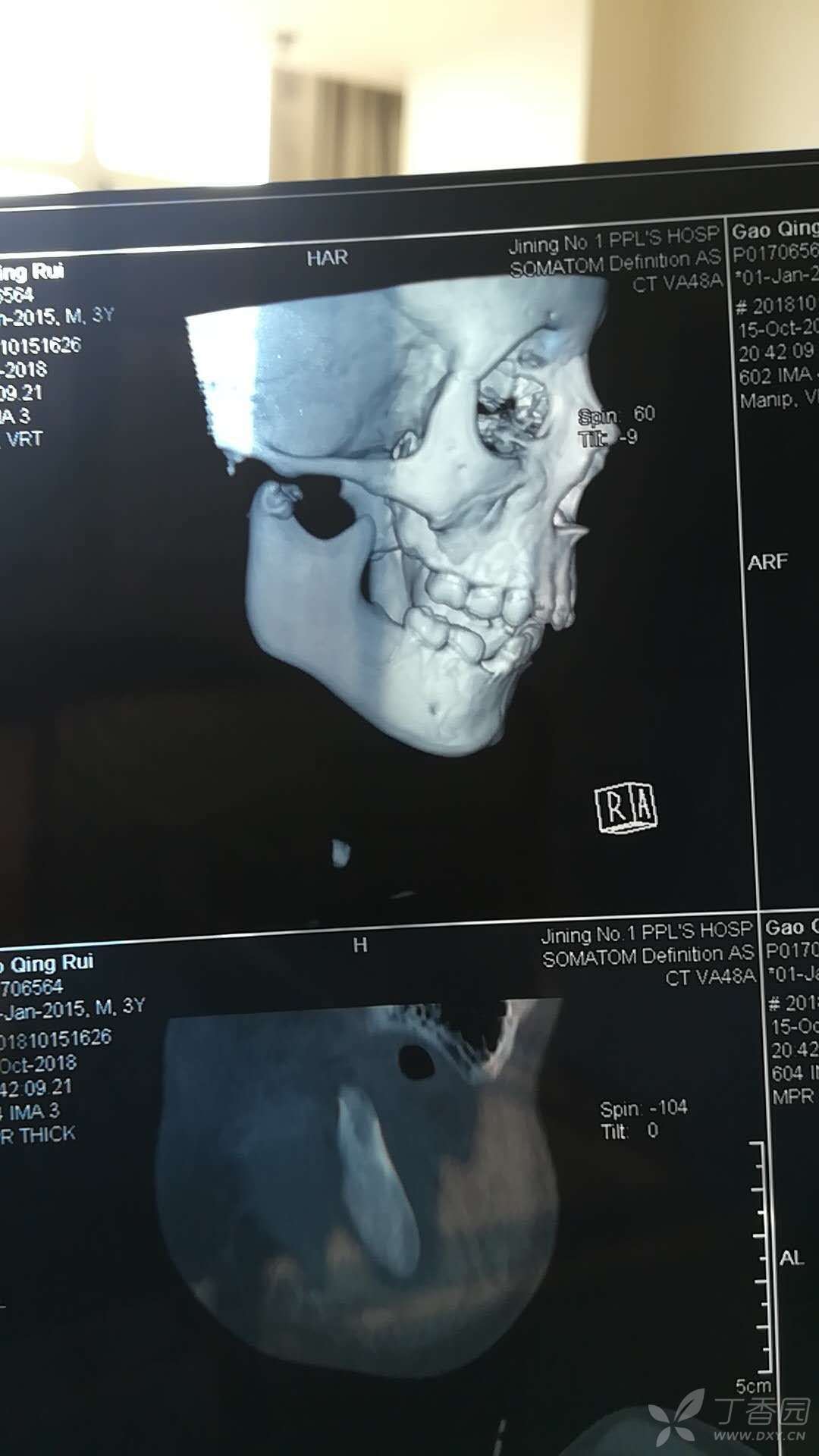 双侧髁突粉碎性骨折 下颌骨骨体骨折
