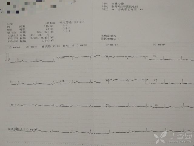 怒吞300 片地高辛全程心电图