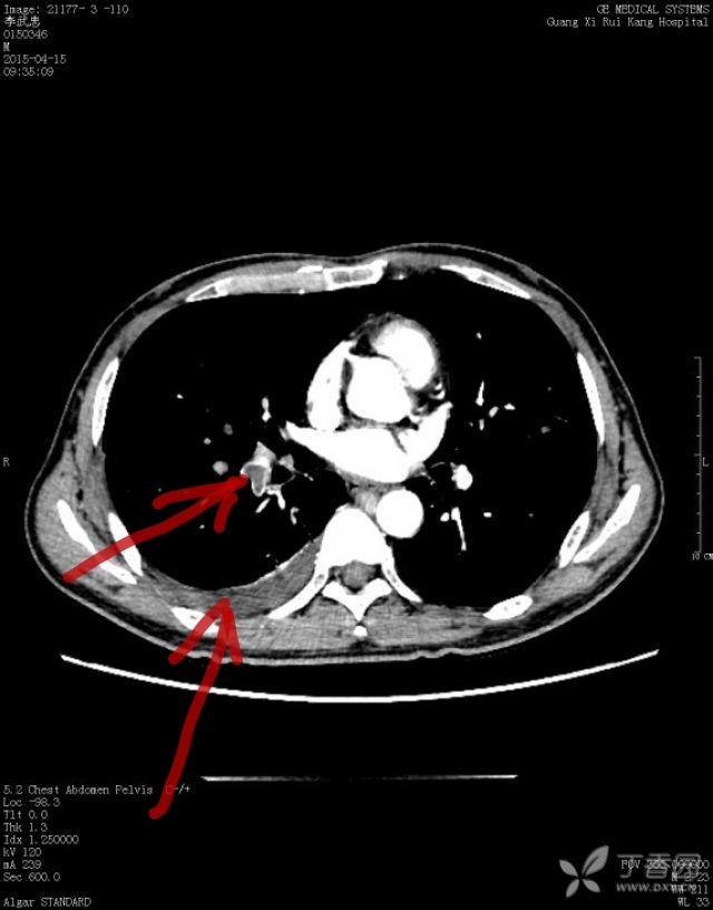 我也不懂看ct,只看出胸腔积液.右肺门血管处好像不太对劲.
