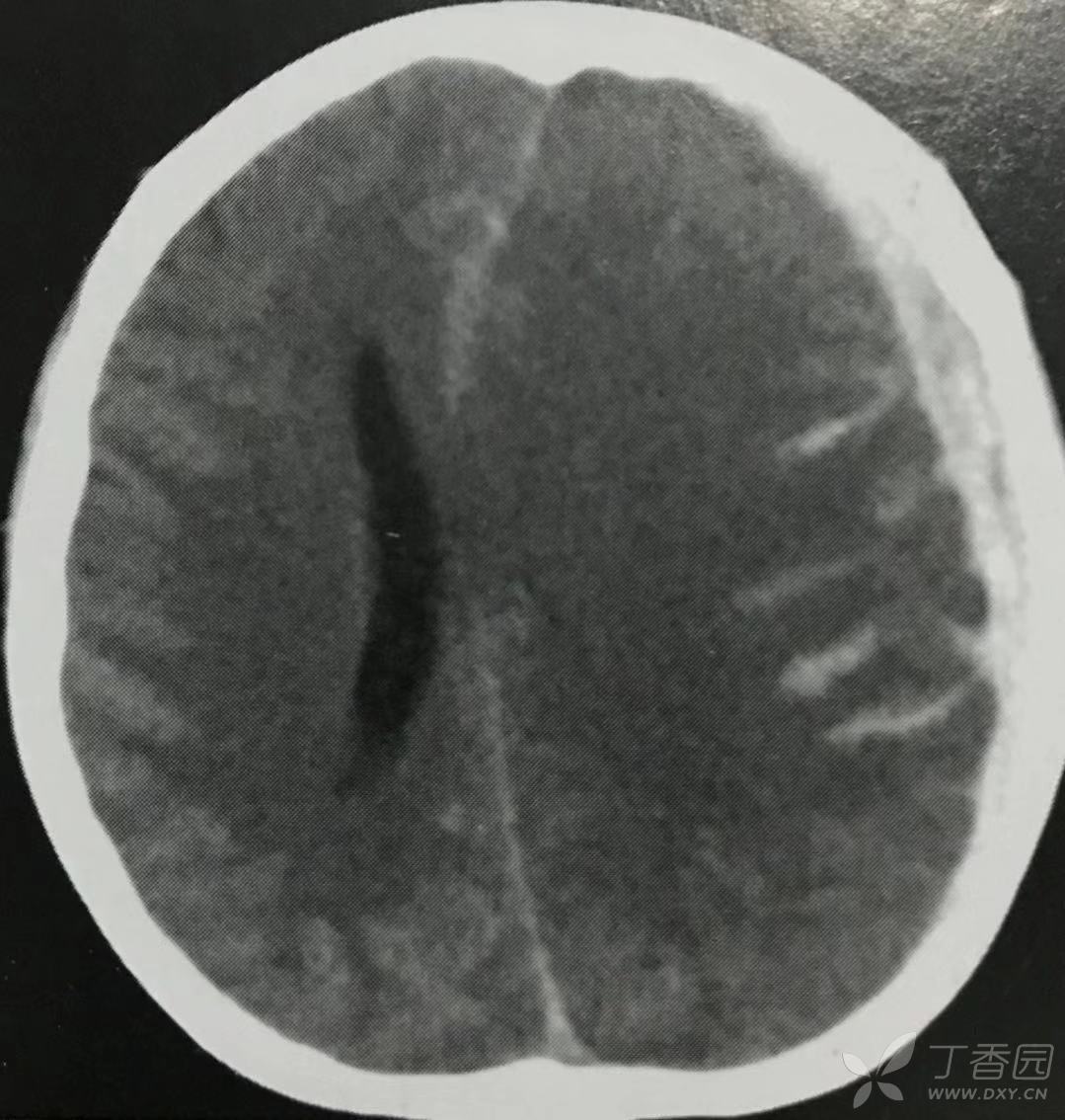 硬膜外血肿 - 影像医学和核医学讨论版 -丁香园论坛