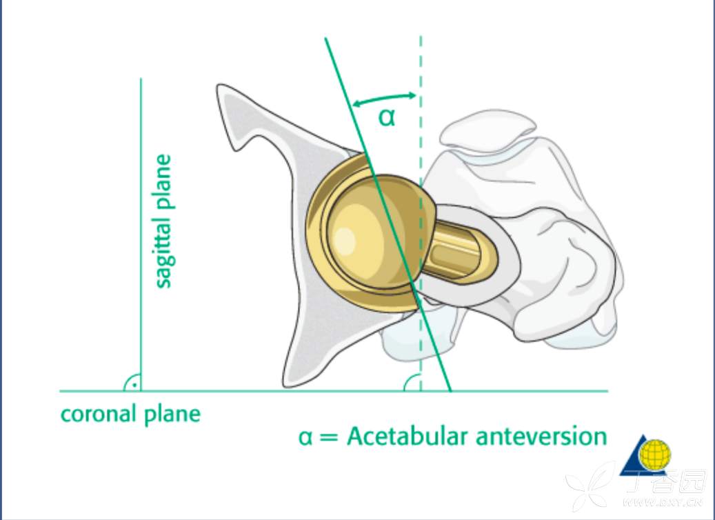 髋臼假体的前倾角和外展角--美图2张