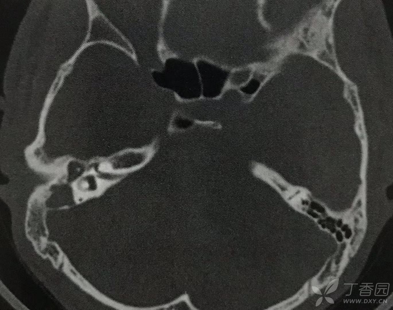 ct表现 1,单纯型患侧乳突气化不良,乳突气房减少,消失,骨质密度增高