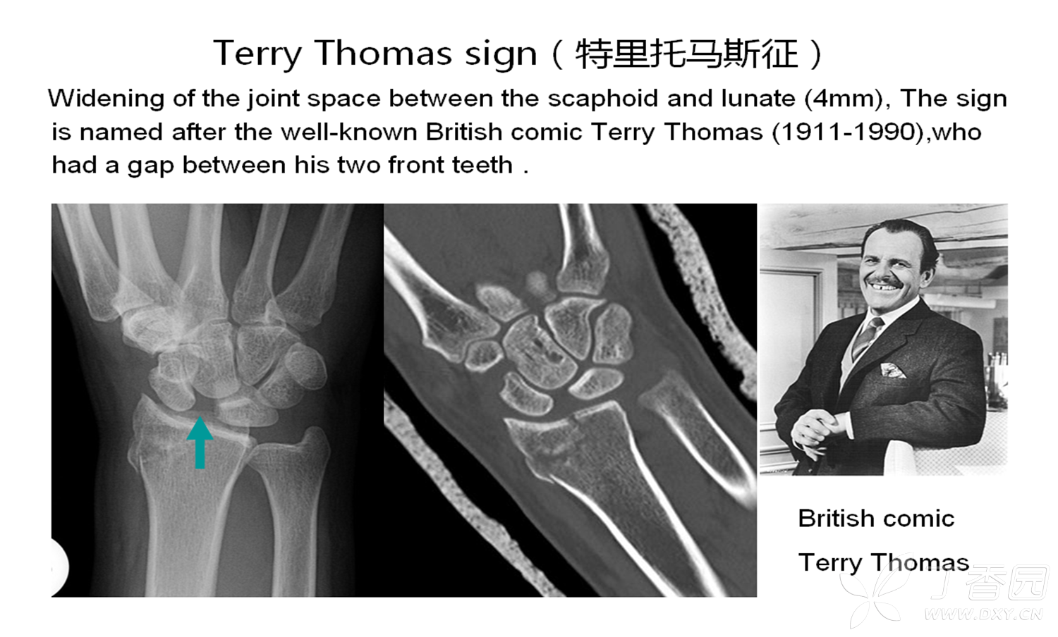 terry thomas sign(特里托马斯征) [病例帖]