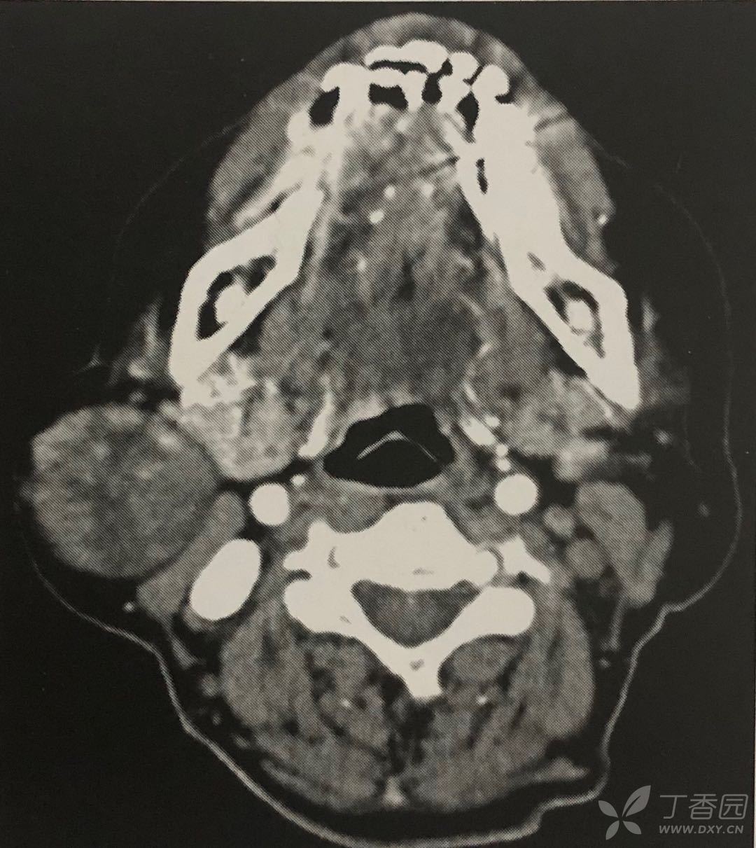 腮腺多形性腺瘤