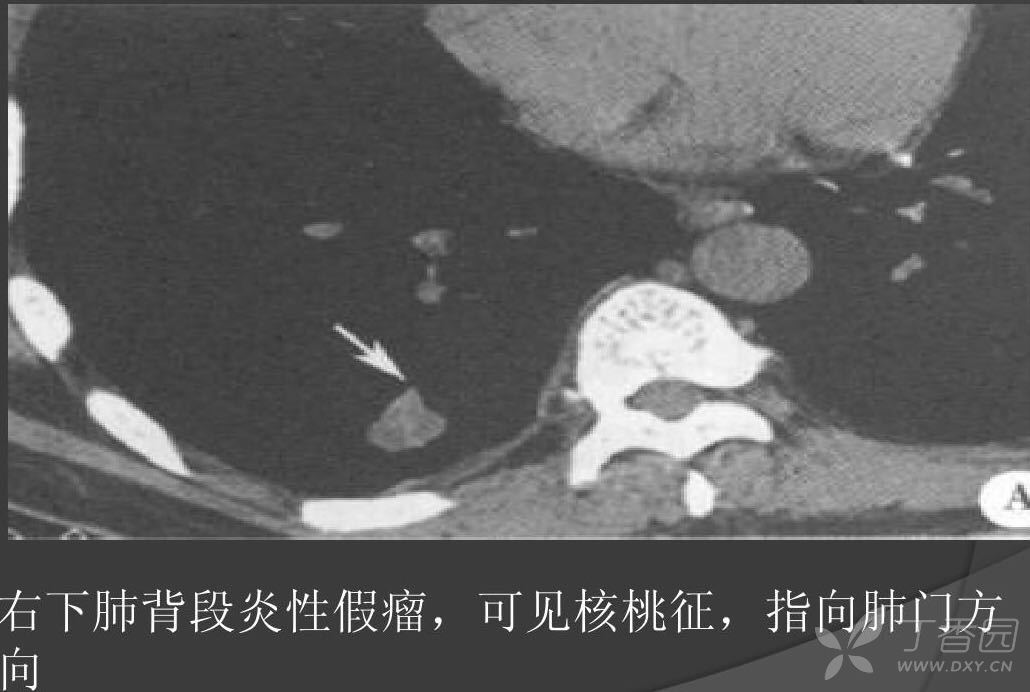 4,炎性假瘤