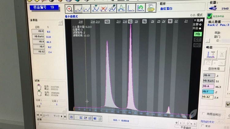 老年人异常血红蛋白电泳结果分析