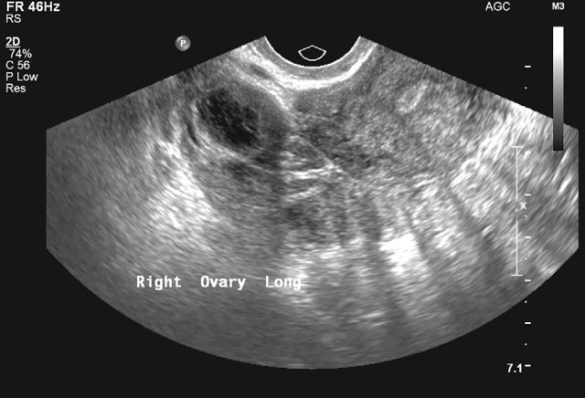 新手福利:异位妊娠的超声诊断和鉴别诊断