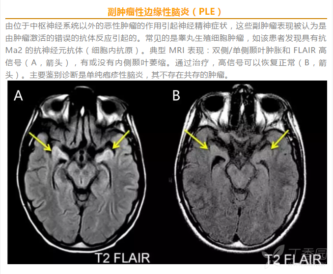 【快速问答-7】:瞳孔对光反射消失(答案已公布)