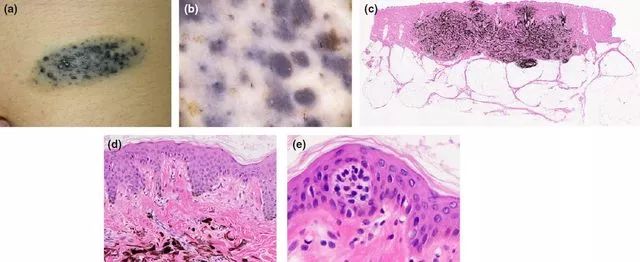 今日病例斑点状分布的联合痣