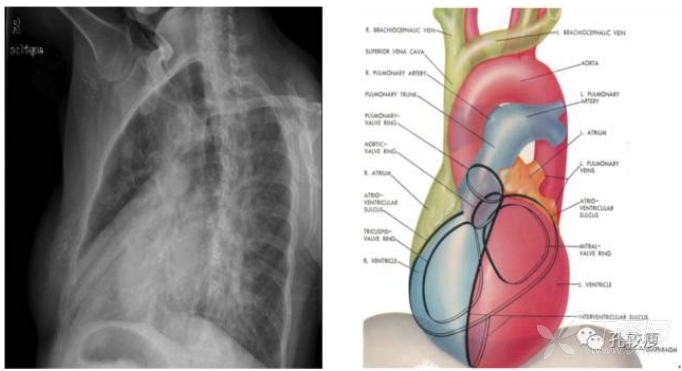 心脏及大血管在胸部后前位胸片中的投影