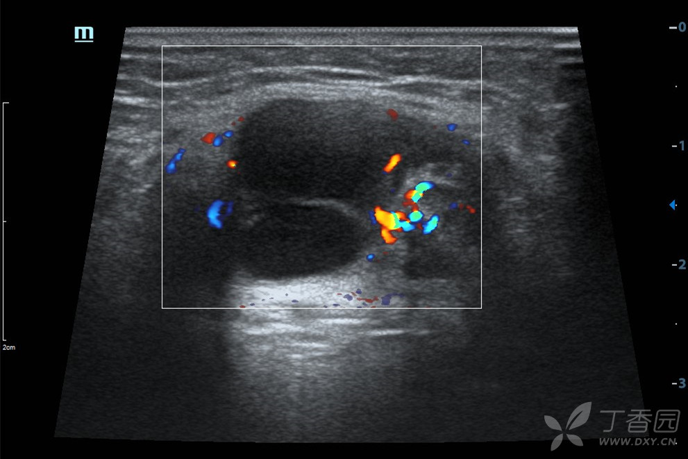 周围及分隔可见血流信号 结合图像及病史,不难诊断:甲状舌管囊肿伴