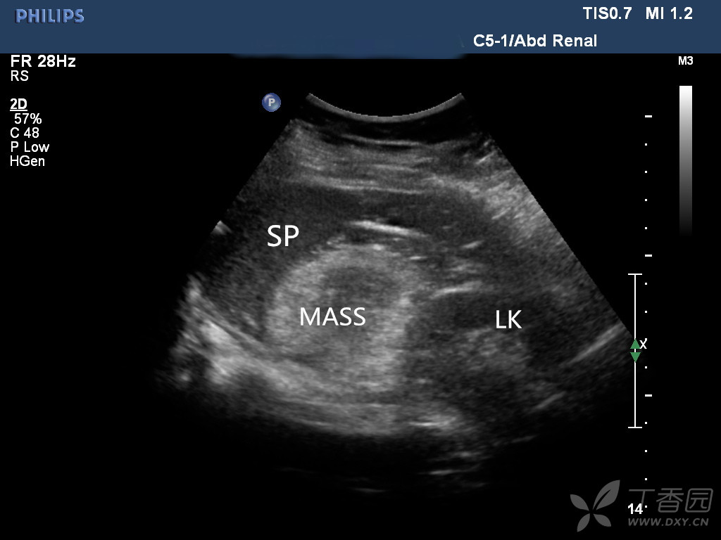 再来一例容易误诊的肾错构瘤 - 超声医学讨论版 -丁香园论坛