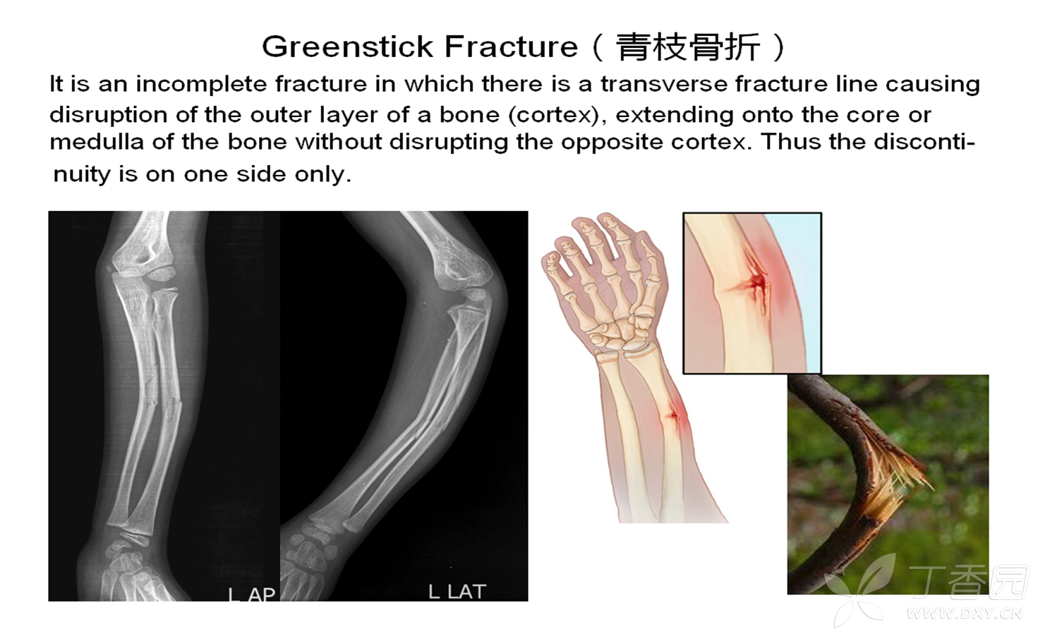 greenstick fracture(青枝骨折) 01-04 10:24   关注      点赞 收藏