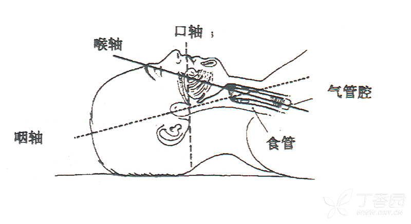 漫话操作:超详细「气管插管」步骤教程(新手入门必看)