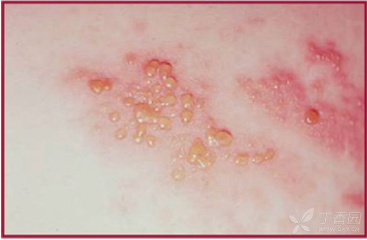 带状疱疹(herpes zoster)是一种疼痛性皮疹,通常称为带状疱疹