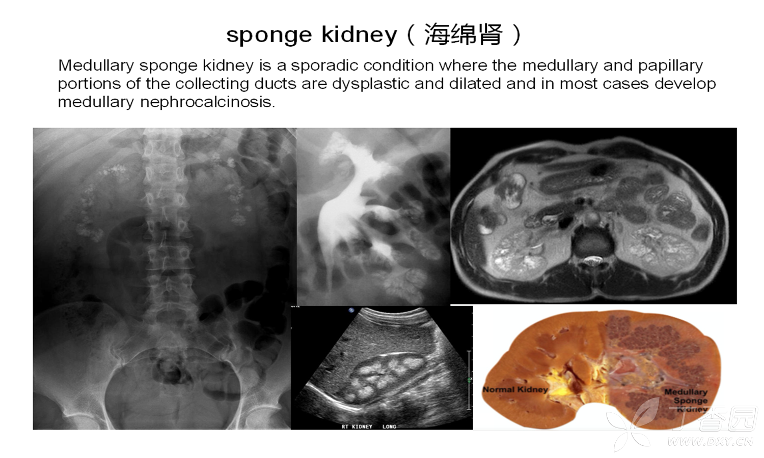 sponge kidney(海绵肾) [病例帖]