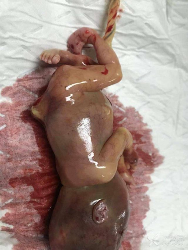 看图识病:这一例流产的胎儿,你能看出原因吗?