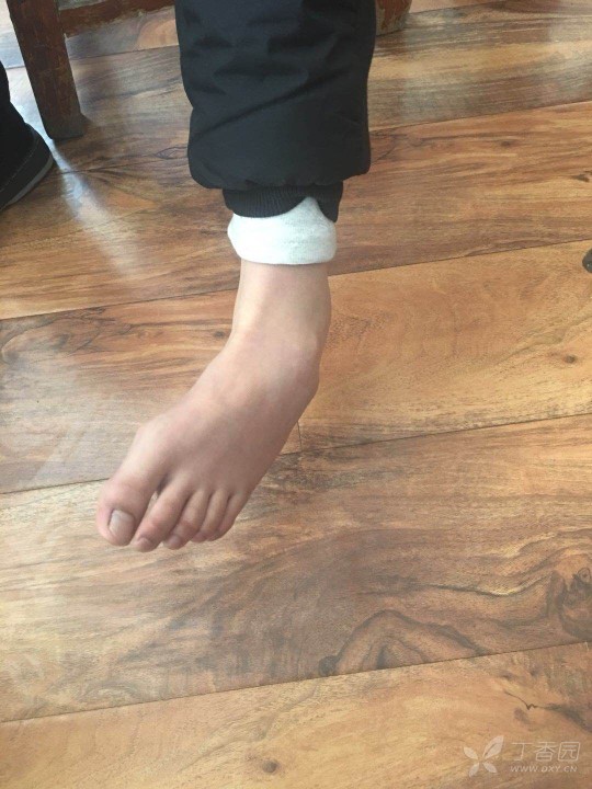 足内翻图片