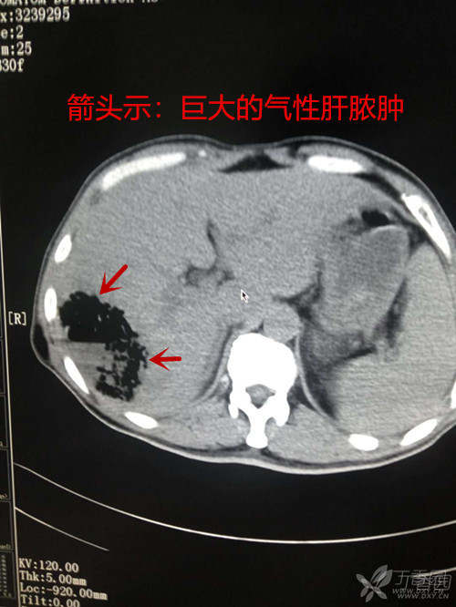 产气的肝脓肿(公布结果?