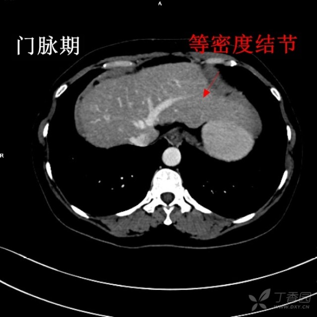 小肝癌