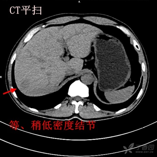 小肝癌