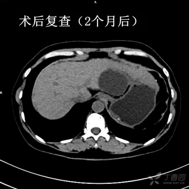 小肝癌ct表现