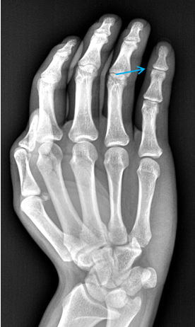 右手小指远节指骨指间关节旁见点状中等密度阴影 例十