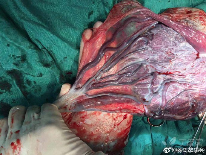 帆状胎盘, 幸好b超提示血管前置, 这么粗的血管, 里面都是宝宝的血.