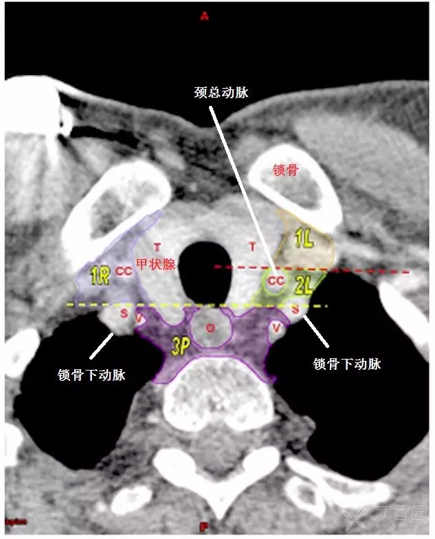 纵膈淋巴结:最新分组方法,最经典图谱