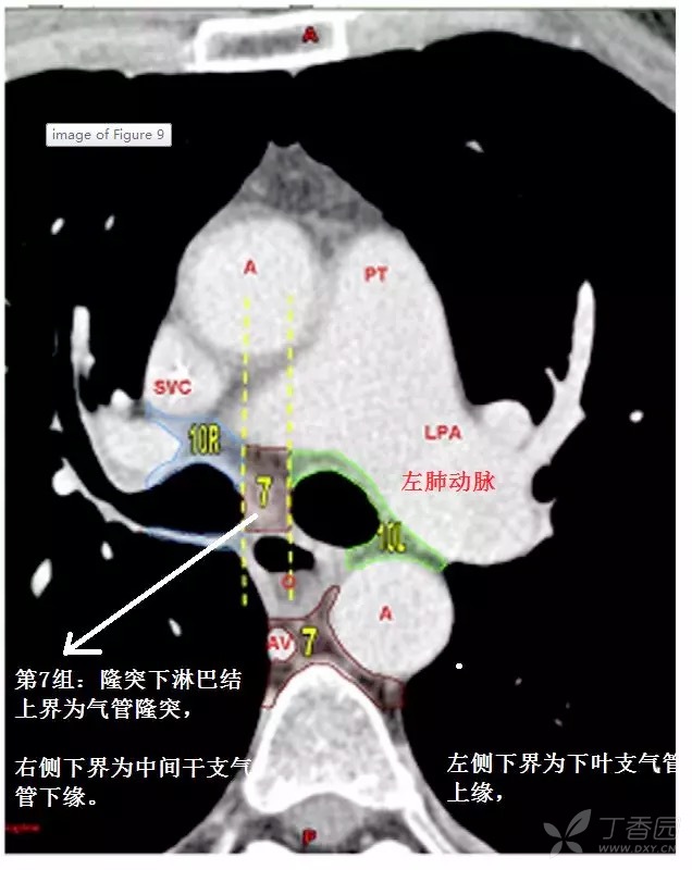 第7组:隆突下淋巴结 上界为气管隆突,左侧下界为下叶支气管上缘,右侧