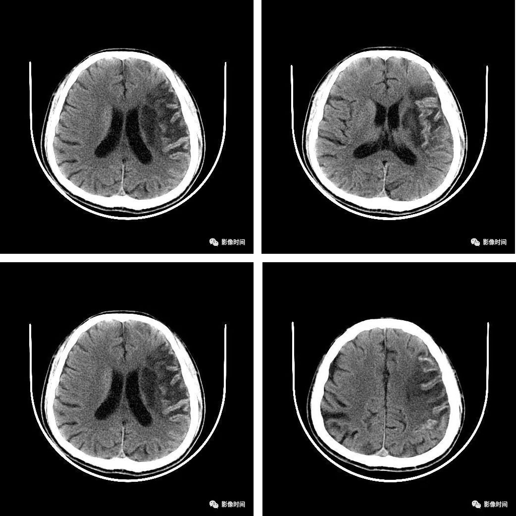 这种脑梗后的影像表现可别误诊为脑出血