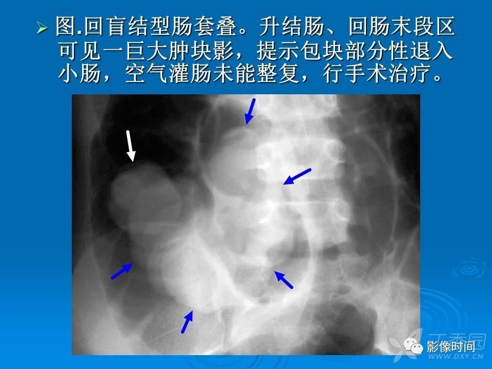 来源:华夏览雄 影像时间 本文重点讨论肠套叠分型,为什么现多用空气