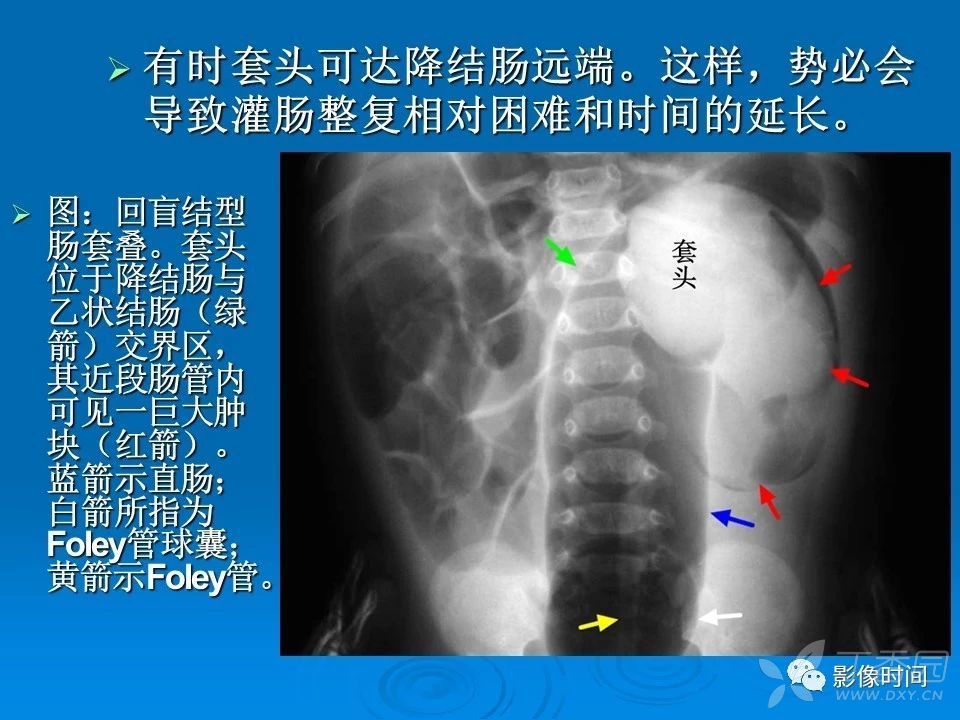 来源:华夏览雄 影像时间 本文重点讨论肠套叠分型,为什么现多用空气