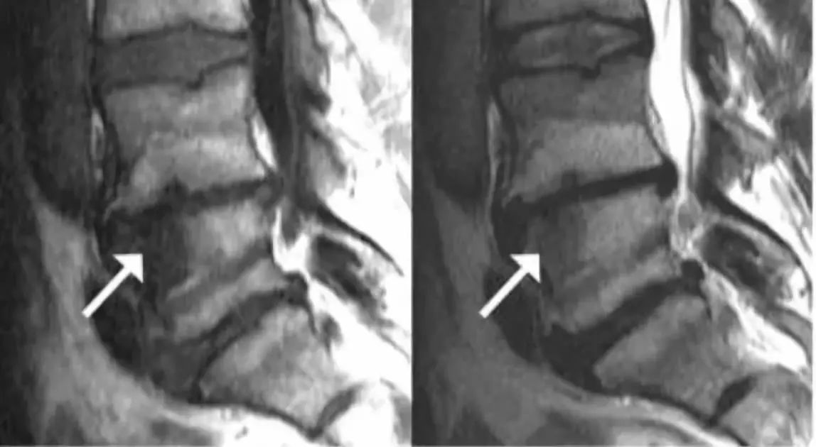 箭头所指为 3 型表现,l4,l5 椎体上缘的后半部分及 s1 上缘为 modic 2