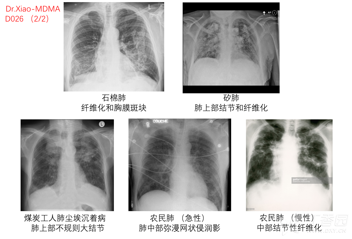 xiao-mdma d026:   与职业暴露有关的肺部疾病(尘肺,pneumoconiosis)